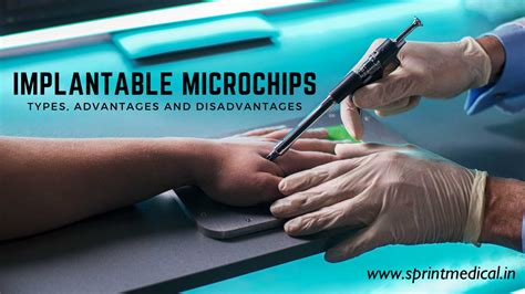 rfid chip in tooth|Microchip implant (human) .